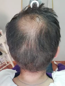 antes de tratamiento actividerma