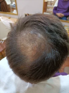 despues de tratamiento actividerma